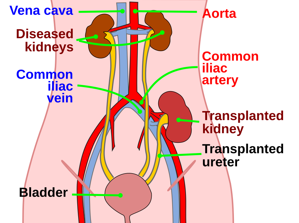 Kidney location after transplantation.
