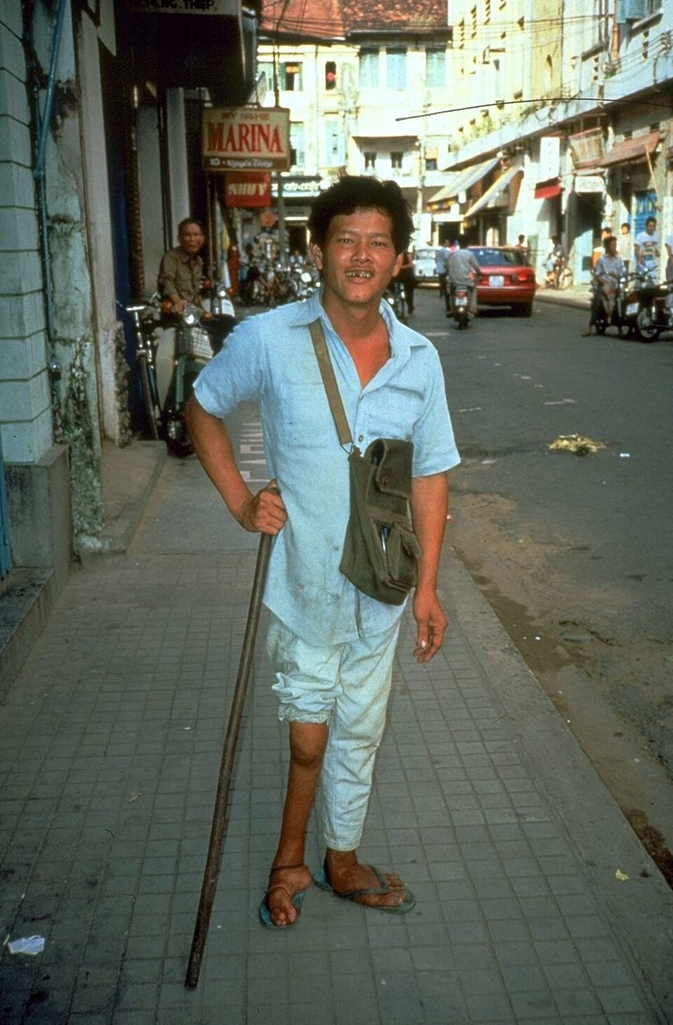 Man on street with atrophy and paralysis of the right leg and foot due to polio.